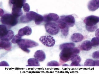 Poorly differentiated thyroid carcinoma. Aspirates show marked
pleomorphism which are mitotically active.
 