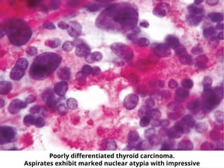 Poorly differentiated thyroid carcinoma.
Aspirates exhibit marked nuclear atypia with impressive
 