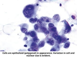 Cells are epithelioid (polygonal) in appearance. Variation in cell and
nuclear size is evident.
 