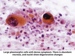 Large pleomorphic cells with dense cytoplasm. There is abundant
necrosis, and nuclei show degenerative changes
 