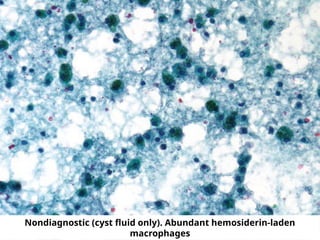 Nondiagnostic (cyst fluid only). Abundant hemosiderin-laden
macrophages
 