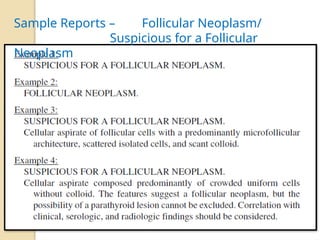 Sample Reports – Follicular Neoplasm/
Suspicious for a Follicular
Neoplasm
 