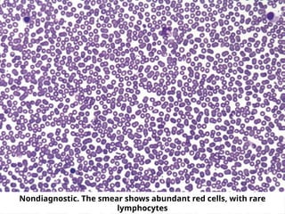 Nondiagnostic. The smear shows abundant red cells, with rare
lymphocytes
 