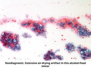 Nondiagnostic. Extensive air-drying artifact in this alcohol-fixed
smear
 