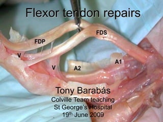 Flexor tendon repairs
Tony Barabás
Colville Team teaching
St George’s Hospital
19th June 2009
 
