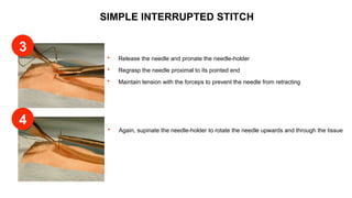 SIMPLE INTERRUPTED STITCH
 Release the needle and pronate the needle-holder
 Regrasp the needle proximal to its pointed end
 Maintain tension with the forceps to prevent the needle from retracting
 Again, supinate the needle-holder to rotate the needle upwards and through the tissue
3
4
 