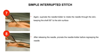 SIMPLE INTERRUPTED STITCH
 Again, supinate the needle-holder to rotate the needle through the skin,
keeping the shaft 90° to the skin surface
 After releasing the needle, pronate the needle-holder before regrasping the
needle
7
8
 