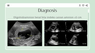 Oligohidramnion berat bila indeks cairan amnion ≤5 cm
Diagnosis
 