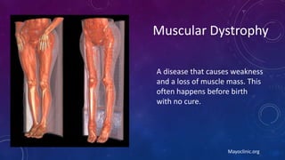 Muscular Dystrophy
A disease that causes weakness
and a loss of muscle mass. This
often happens before birth
with no cure.
Mayoclinic.org
 