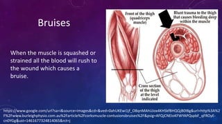 https://www.google.com/url?sa=i&source=images&cd=&ved=0ahUKEwi1jf_O8qnMAhUJox4KHSkfBHQQjB0IBg&url=http%3A%2
F%2Fwww.burleighphysio.com.au%2Farticle%2Fcorksmuscle-contusionsbruises%2F&psig=AFQjCNEIoKFWYAPQspbF_qFROyE-
cn0YGg&ust=1461677324814065&rct=j
Bruises
When the muscle is squashed or
strained all the blood will rush to
the wound which causes a
bruise.
 