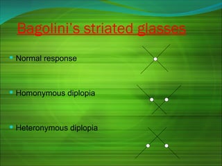 Bagolini’s striated glasses
 Normal response
 Homonymous diplopia
 Heteronymous diplopia
 