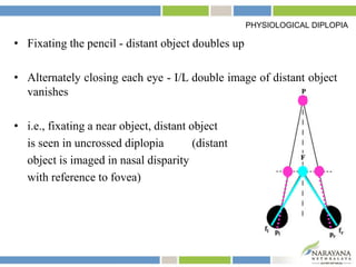 • Fixating the pencil - distant object doubles up
• Alternately closing each eye - I/L double image of distant object
vanishes
• i.e., fixating a near object, distant object
is seen in uncrossed diplopia (distant
object is imaged in nasal disparity
with reference to fovea)
PHYSIOLOGICAL DIPLOPIA
 