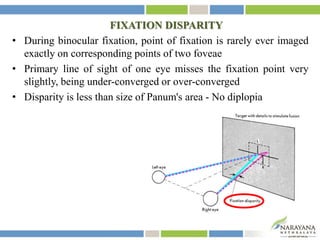 FIXATION DISPARITY
• During binocular fixation, point of fixation is rarely ever imaged
exactly on corresponding points of two foveae
• Primary line of sight of one eye misses the fixation point very
slightly, being under-converged or over-converged
• Disparity is less than size of Panum's area - No diplopia
 