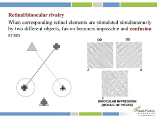 Retinal/binocular rivalry
When corresponding retinal elements are stimulated simultaneously
by two different objects, fusion becomes impossible and confusion
arises
OD OS
BINOCULAR IMPRESSION
(MOSAIC OF PIECES)
 