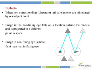 Diplopia
• When non-corresponding (disparate) retinal elements are stimulated
by one object point
• Image in the non-fixing eye falls on a location outside the macula
and is projected to a different
point in space
• Image in non-fixing eye is more
faint than that in fixing eye
 