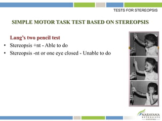 SIMPLE MOTOR TASK TEST BASED ON STEREOPSIS
Lang’s two pencil test
• Stereopsis +nt - Able to do
• Stereopsis -nt or one eye closed - Unable to do
TESTS FOR STEREOPSIS
 