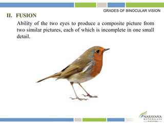 II. FUSION
Ability of the two eyes to produce a composite picture from
two similar pictures, each of which is incomplete in one small
detail.
GRADES OF BINOCULAR VISION
 