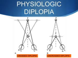 PHYSIOLOGIC
DIPLOPIA
CROSSED DIPLOPIA UNCROSSED DIPLOPIA
 