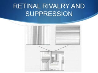 RETINAL RIVALRY AND
SUPPRESSION
 