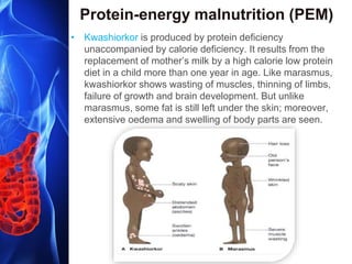 Protein-energy malnutrition (PEM)
• Kwashiorkor is produced by protein deficiency
unaccompanied by calorie deficiency. It results from the
replacement of mother’s milk by a high calorie low protein
diet in a child more than one year in age. Like marasmus,
kwashiorkor shows wasting of muscles, thinning of limbs,
failure of growth and brain development. But unlike
marasmus, some fat is still left under the skin; moreover,
extensive oedema and swelling of body parts are seen.
 
