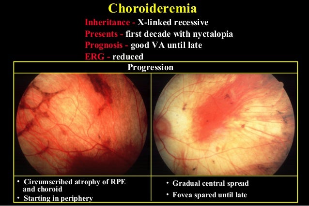 47 Hereditary Choroidal Dystropathies 47 Hereditary Choroidal Dystropathies