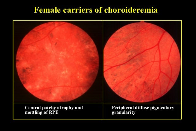 Choriocapillaris 4 Female Carriers Of Choroideremia Choriocapillaris 4 Female Carriers Of Choroideremia