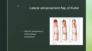 z
Lateral advancement flap of Kutler
 Used for transverse or
dorsal oblique
amputations
 