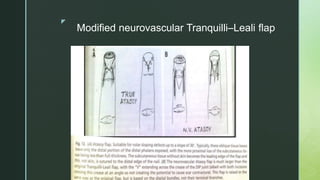 z
Modified neurovascular Tranquilli–Leali flap
 
