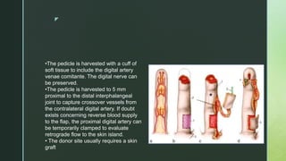 z
•The pedicle is harvested with a cuff of
soft tissue to include the digital artery
venae comitante. The digital nerve can
be preserved.
•The pedicle is harvested to 5 mm
proximal to the distal interphalangeal
joint to capture crossover vessels from
the contralateral digital artery. If doubt
exists concerning reverse blood supply
to the flap, the proximal digital artery can
be temporarily clamped to evaluate
retrograde flow to the skin island.
• The donor site usually requires a skin
graft
 