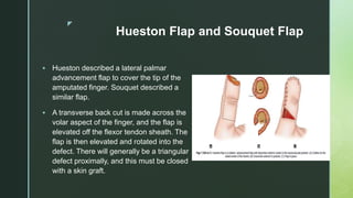 z
Hueston Flap and Souquet Flap
 Hueston described a lateral palmar
advancement flap to cover the tip of the
amputated finger. Souquet described a
similar flap.
 A transverse back cut is made across the
volar aspect of the finger, and the flap is
elevated off the flexor tendon sheath. The
flap is then elevated and rotated into the
defect. There will generally be a triangular
defect proximally, and this must be closed
with a skin graft.
 