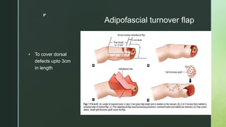 z
Adipofascial turnover flap
 To cover dorsal
defects upto 3cm
in length
 