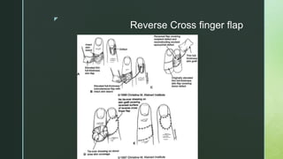 z
Reverse Cross finger flap
 