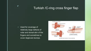 z
Turkish /C-ring cross finger flap
 Used for coverage of
relatively large defects of
volar and dorsal skin of the
fingers and sometimes to
cover degloved stumps.
 