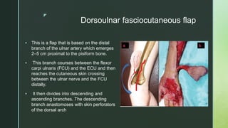 z
Dorsoulnar fasciocutaneous flap
 This is a flap that is based on the distal
branch of the ulnar artery which emerges
2–5 cm proximal to the pisiform bone.
 This branch courses between the flexor
carpi ulnaris (FCU) and the ECU and then
reaches the cutaneous skin crossing
between the ulnar nerve and the FCU
distally.
 It then divides into descending and
ascending branches. The descending
branch anastomoses with skin perforators
of the dorsal arch
 