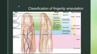 z
Classification of fingertip amputation
 