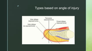 z
Types based on angle of injury
 