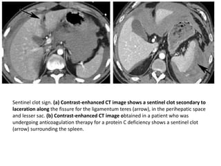 Sentinel Sign Radiology Imaging in blunt abdominal trauma | PPTX