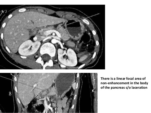 Blunt injury abdomen dissertation