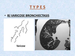 lung bronchiectasis pulmonology ( respiratory medicine ) | PPTX