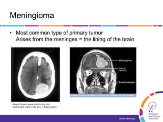 Meningioma
• Most common type of primary tumor
Arises from the meninges = the lining of the brain
Google Images, www.student.bmj.com
(Left is right, right is left, bone is bright white)
 