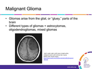 Malignant Glioma
• Gliomas arise from the glial, or “gluey,” parts of the
brain
• Different types of gliomas = astrocytomas,
oligodendrogliomas, mixed gliomas
(Left is right, right is left, bone is bright white,
malignant tumor with contrast dye is grey)
Midline shift, Google Images,
http://www.ispub.com/xml/journals/ija/vol8n2/pregnant
-fig1.jpg
 