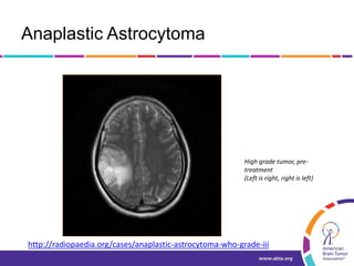 Anaplastic Astrocytoma
High grade tumor, pre-
treatment
(Left is right, right is left)
http://radiopaedia.org/cases/anaplastic-astrocytoma-who-grade-iii
 