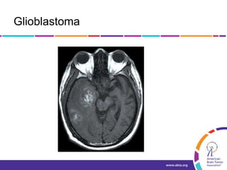 Glioblastoma
 
