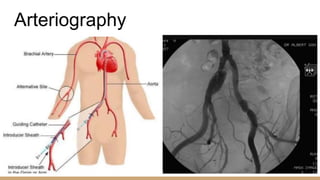 Arteriography
 