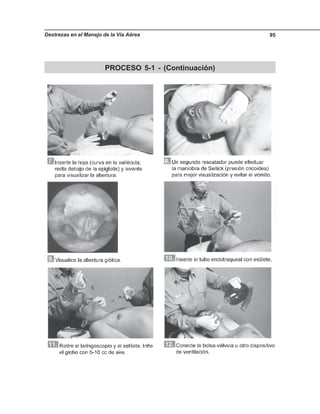 Destrezas en el Manejo de la Vía Aérea 95
PROCESO 5-1 - (Continuación)
 