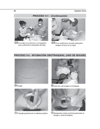 Capítulo Cinco96
PROCESO 5-1 - (Continuación)
PROCESO 5-2 - INTUBACIÓN OROTRAQUEAL (USO DE BOUGIE)
 