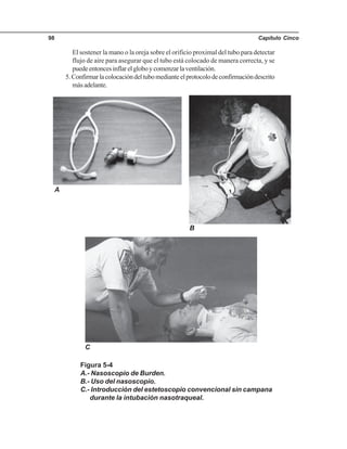 Capítulo Cinco98
El sostener la mano o la oreja sobre el orificio proximal del tubo para detectar
flujo de aire para asegurar que el tubo está colocado de manera correcta, y se
puedeentoncesinflarelgloboycomenzarlaventilación.
5.Confirmarlacolocacióndeltubomedianteelprotocolodeconfirmacióndescrito
másadelante.
Figura 5-4
A.- Nasoscopio de Burden.
B.- Uso del nasoscopio.
C.- Introducción del estetoscopio convencional sin campana
durante la intubación nasotraqueal.
A
B
C
 