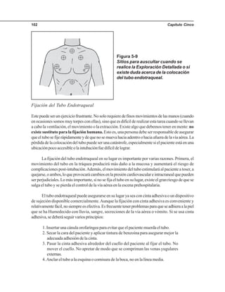 Capítulo Cinco102
Fijación del Tubo Endotraqueal
Estepuedeserunejerciciofrustrante.Nosolorequieredefinosmovimientosdelasmanos(cuando
en ocasiones somos muy torpes con ellas), sino que es difícil de realizar esta tarea cuando se llevan
a cabo la ventilación, el movimiento o la extracción. Existe algo que debemos tener en mente: no
existe sustituto para la fijación humana. Esto es, una persona debe ser responsable de asegurar
queeltubosefijerápidamenteydequenosemuevahaciaadentroohaciaafueradelavíaaérea.La
pérdida de la colocación del tubo puede ser una catástrofe, especialmente si el paciente está en una
ubicaciónpocoaccesibleolaintubaciónfuedifícildelograr.
La fijación del tubo endotraqueal en su lugar es importante por varias razones. Primera, el
movimiento del tubo en la tráquea producirá más daño a la mucosa y aumentará el riesgo de
complicaciones post-intubación.Además, el movimiento del tubo estimulará al paciente a toser, a
quejarse,oambos,loqueprovocarácambiosenlapresióncardiovasculareintracranealquepueden
ser perjudiciales. Lo más importante, si no se fija el tubo en su lugar, existe el gran riesgo de que se
salga el tubo y se pierda el control de la vía aérea en la escena prehospitalaria.
El tubo endotraqueal puede asegurarse en su lugar ya sea con cinta adhesiva o un dispositivo
de sujeción disponible comercialmente.Aunque la fijación con cinta adhesiva es conveniente y
relativamentefácil,nosiempreesefectiva.Esfrecuentetenerproblemasparaqueseadhieraalapiel
que se ha Humedecido con lluvia, sangre, secreciones de la vía aérea o vómito. Si se usa cinta
adhesiva,sedeberáseguirvariosprincipios:
1. Insertar una cánula orofaríngea para evitar que el paciente muerda el tubo.
2. Secar la cara del paciente y aplicar tintura de benzoína para asegurar mejor la
adecuada adhesión de la cinta.
3. Pasar la cinta adhesiva alrededor del cuello del paciente al fijar el tubo. No
mover el cuello. No apretar de modo que se compriman las venas yugulares
externas.
4.Anclar el tubo a la esquina o comisura de la boca, no en la línea media.
Figura 5-9
Sitios para auscultar cuando se
realice la Exploración Detallada o si
existe duda acerca de la colocación
del tubo endotraqueal.
 