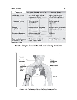 Trauma Torácico 113
Tabla 6-1 Comparación entre Neumotórax a Tensión y Hemotórax.
Figura 6-8 Hallazgos físicos del hemotórax masivo.
 