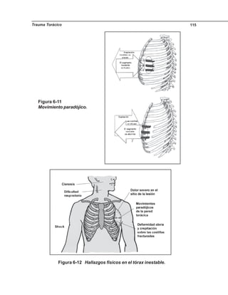 Trauma Torácico 115
Figura 6-11
Movimiento paradójico.
Figura 6-12 Hallazgos físicos en el tórax inestable.
 